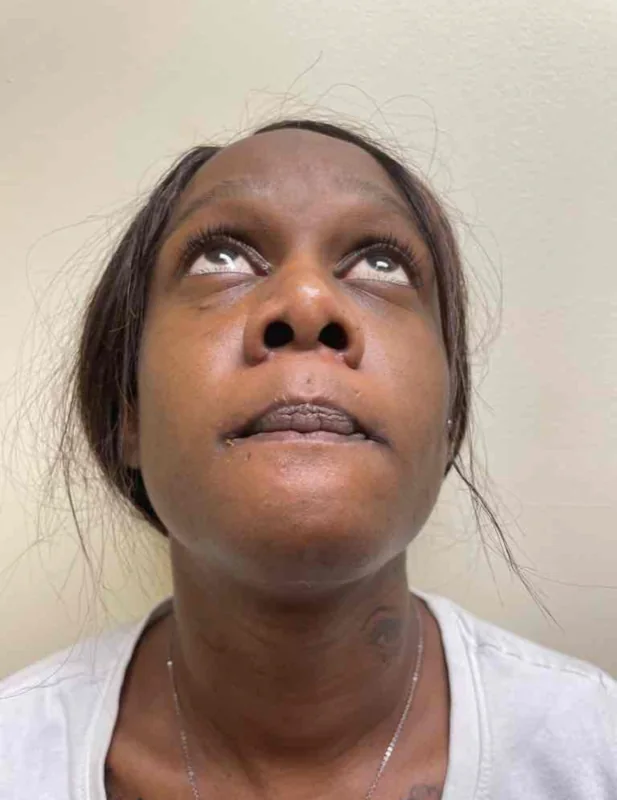 After alar base reduction with rhinoplasty