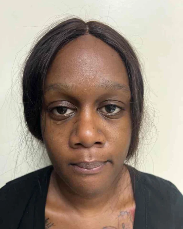 Before alar base reduction with rhinoplasty