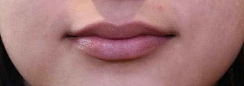 Before lip filler treatment