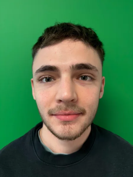 After rhinoplasty front view