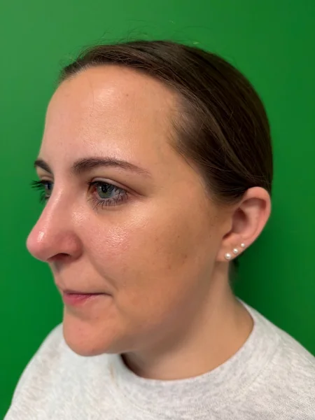 1 month after rhinoplasty oblique view
