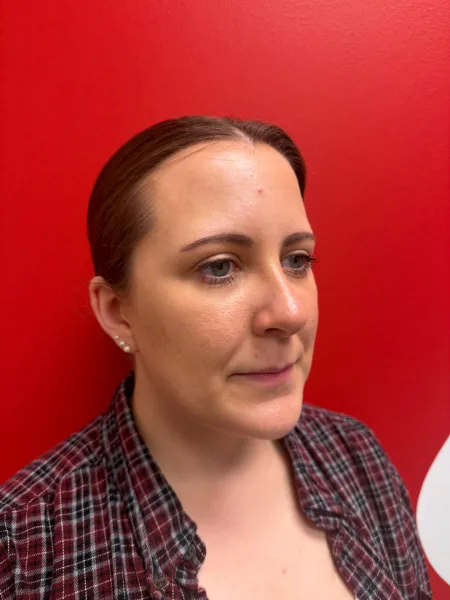 3 months after rhinoplasty right oblique view