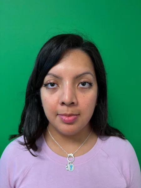 Front view 6 months after rhinoplasty