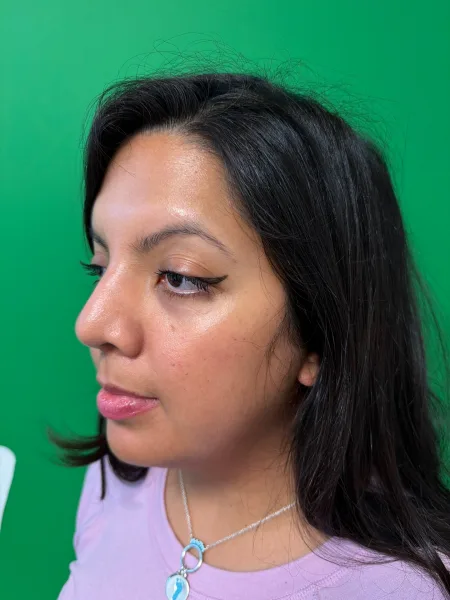 6 months after rhinoplasty oblique view