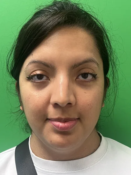 View 1 before rhinoplasty