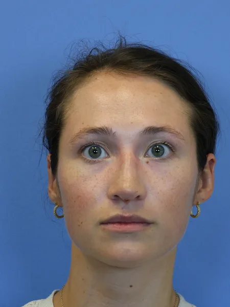 1 month after rhinoplasty front view