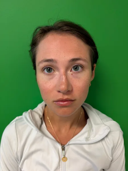 Before rhinoplasty front view