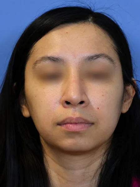 3 months after rhinoplasty front view