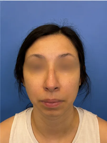Before rhinoplasty front view